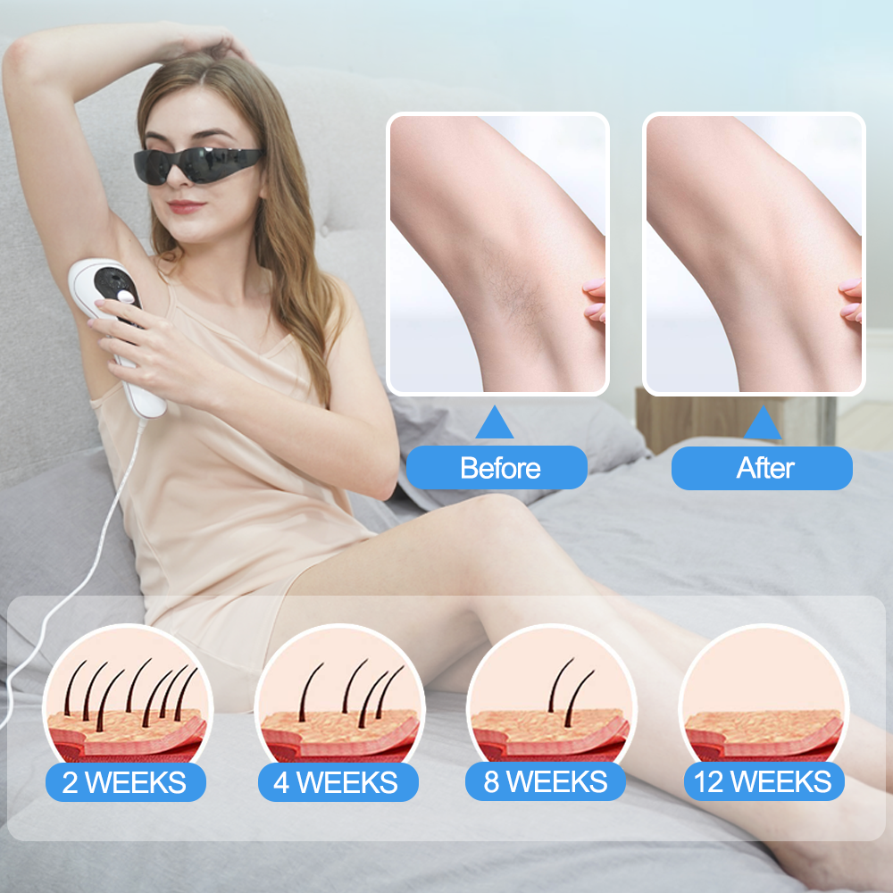 AOHEKANG IPL Laser Hair Removal for Women With ICE & 999,999 Flashes